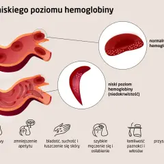 Niski poziom hemoglobiny u osób starszych objawia się bólem głowy, bladością, zmęczeniem i innymi symptomami.