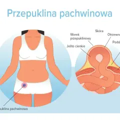 Ilustracja pokazuje, gdzie może być przepuklina pachwinowa – uwypuklenie jelita cienkiego przez osłabione mięśnie brzucha.