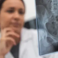 Lekarka analizuje zdjęcie RTG miednicy, szukając oznak złamania kości biodrowej.