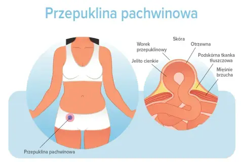 Ilustracja pokazuje, gdzie może być przepuklina pachwinowa – uwypuklenie jelita cienkiego przez osłabione mięśnie brzucha.