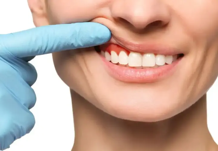 Ból zęba? Czerwone, opuchnięte dziąsła mogą wymagać antybiotyku na zęba. Dentysta bada dziąsła.