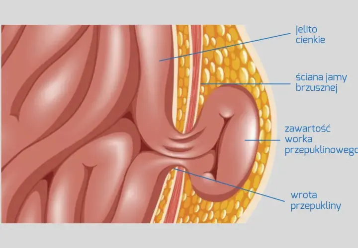 Ilustracja przedstawia przepuklinę u mężczyzn objawy: jelito cienkie przechodzi przez ścianę jamy brzusznej, tworząc worek przepuklinowy.