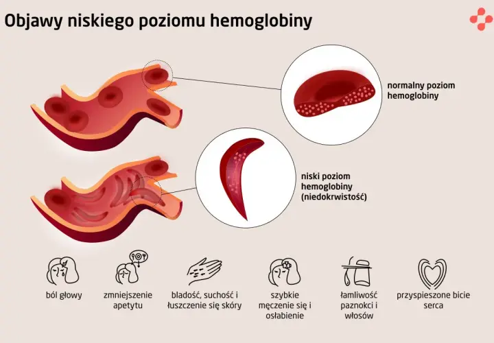 Niski poziom hemoglobiny u osób starszych objawia się bólem głowy, bladością, zmęczeniem i innymi symptomami.