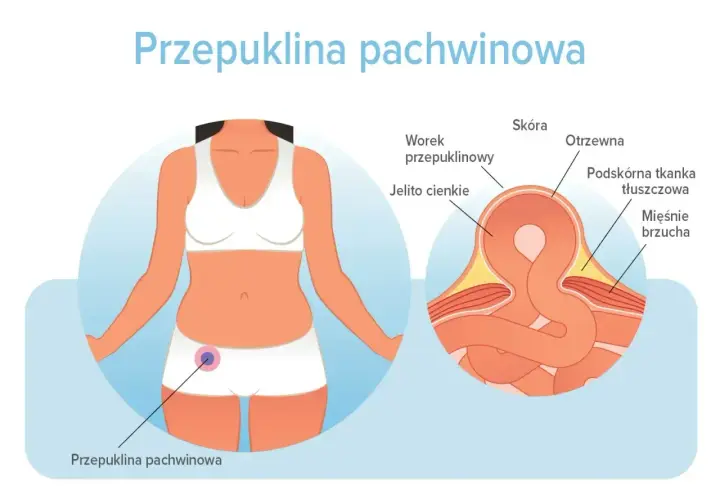 Ilustracja pokazuje, gdzie może być przepuklina pachwinowa – uwypuklenie jelita cienkiego przez osłabione mięśnie brzucha.