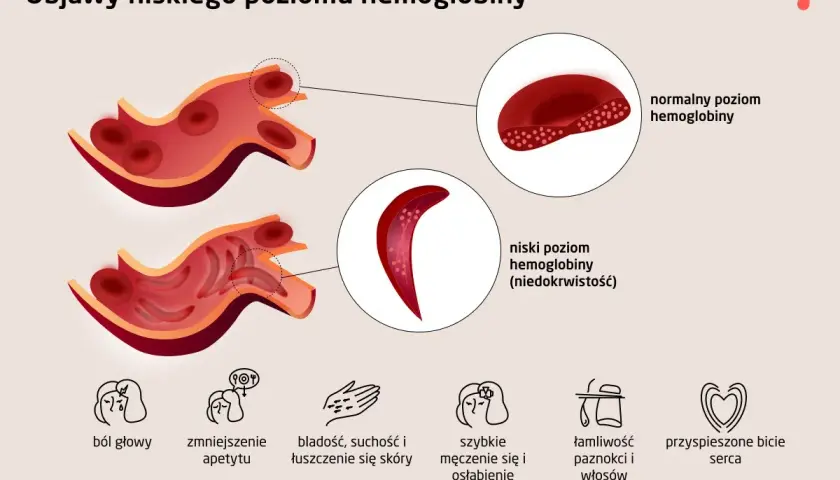 Niski poziom hemoglobiny u osób starszych objawia się bólem głowy, bladością, zmęczeniem i innymi symptomami.