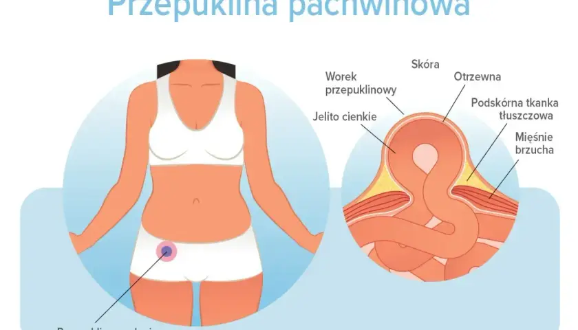 Ilustracja pokazuje, gdzie może być przepuklina pachwinowa – uwypuklenie jelita cienkiego przez osłabione mięśnie brzucha.