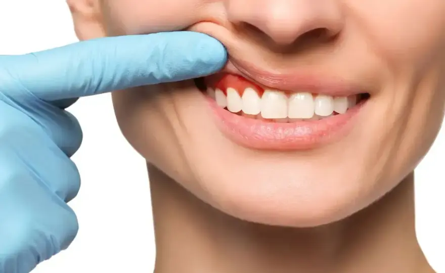 Antybiotyk na zęba - kiedy naprawdę pomaga i kiedy iść do dentysty