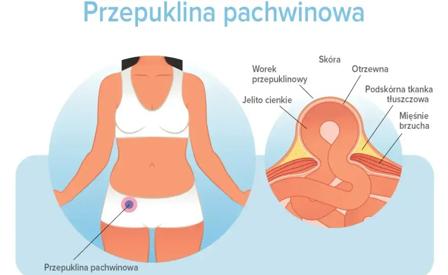 Przepuklina - gdzie boli i kiedy wymaga pilnej pomocy?