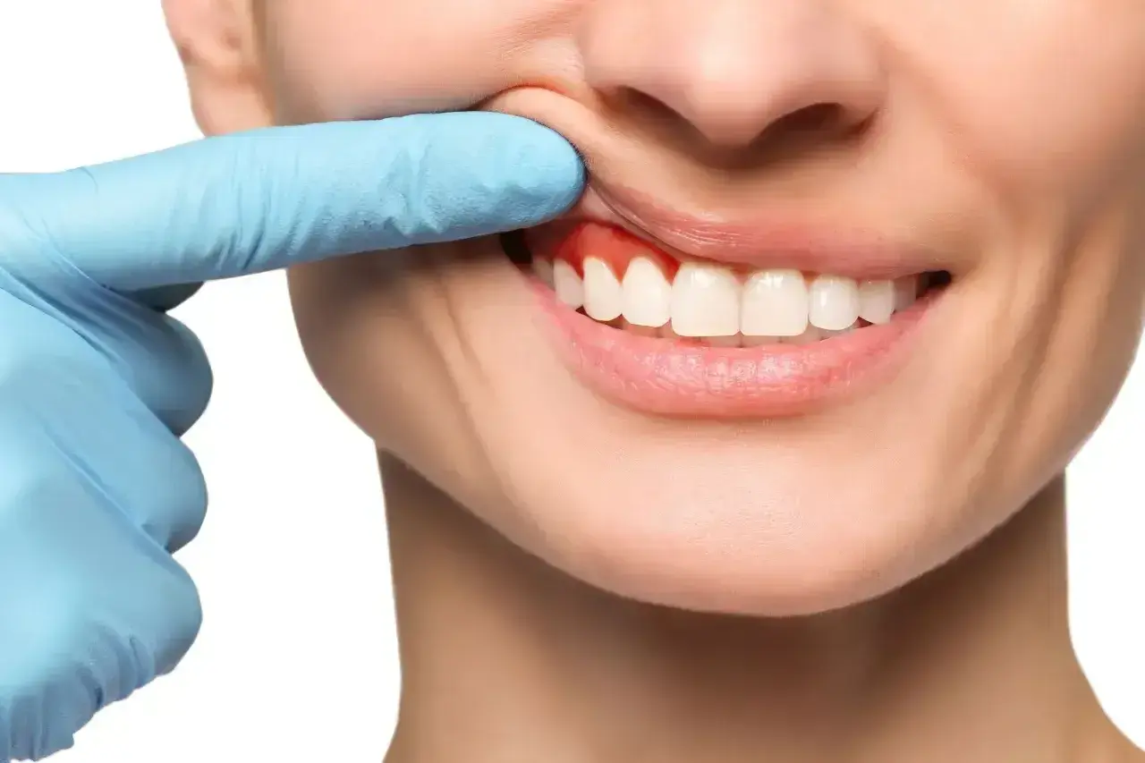 Ból zęba? Czerwone, opuchnięte dziąsła mogą wymagać antybiotyku na zęba. Dentysta bada dziąsła.