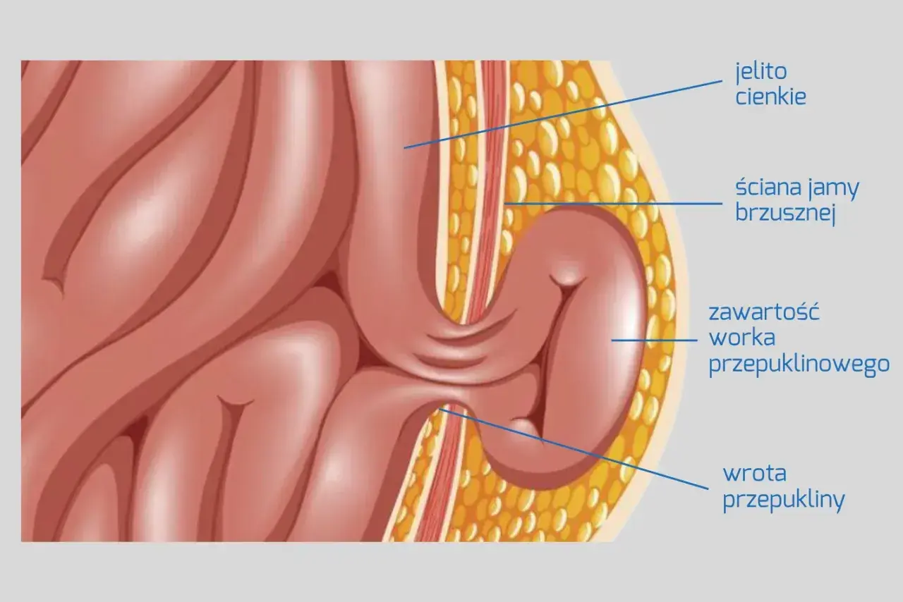 Ilustracja przedstawia przepuklinę u mężczyzn objawy: jelito cienkie przechodzi przez ścianę jamy brzusznej, tworząc worek przepuklinowy.