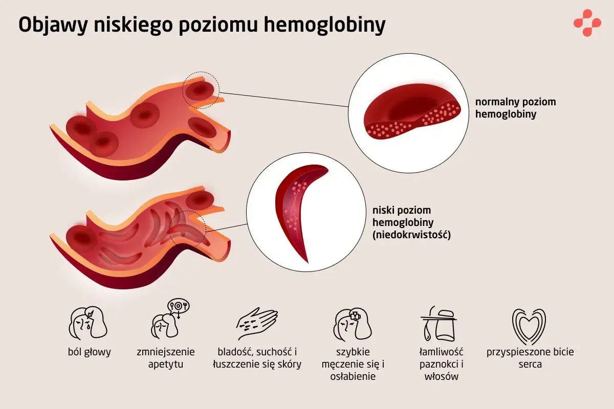 Niski poziom hemoglobiny u osób starszych objawia się bólem głowy, bladością, zmęczeniem i innymi symptomami.
