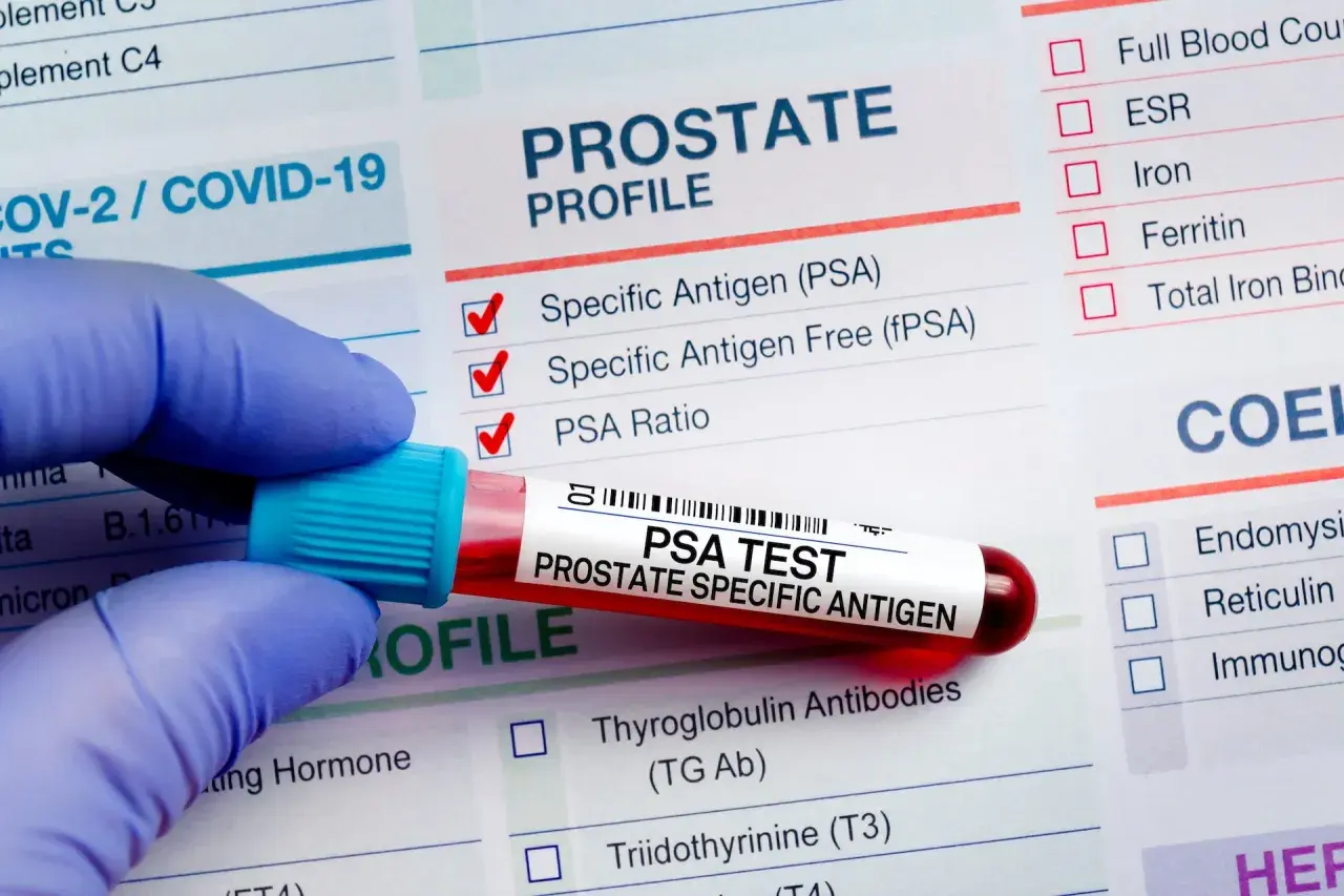 Rękawiczka trzyma probówkę z krwią do badania PSA. Wyniki analizy PSA pomogą ocenić, jak obniżyć psa prostaty.