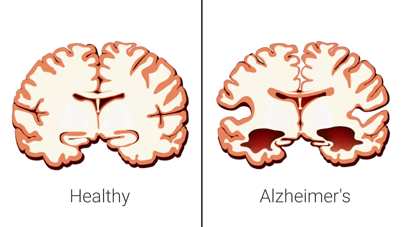 Różne rodzaje demencji, schemat mózgu, choroba Alzheimera
