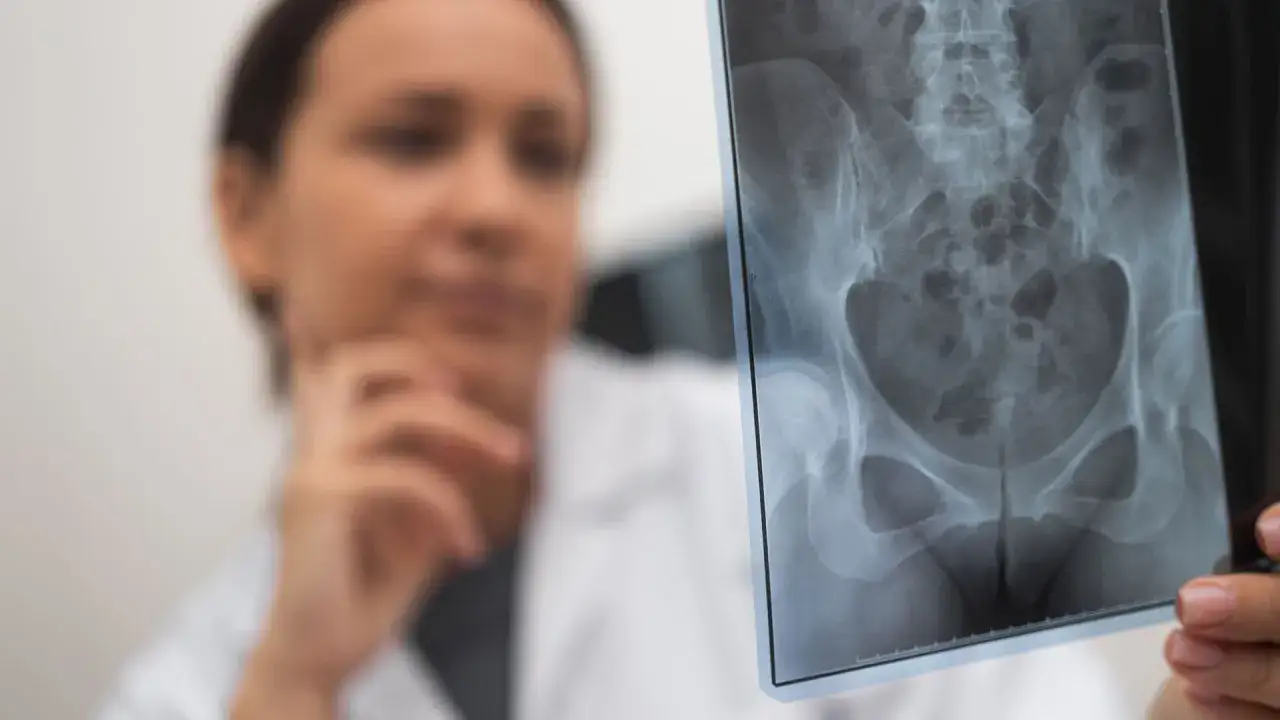 Lekarka analizuje zdjęcie RTG miednicy, szukając oznak złamania kości biodrowej.