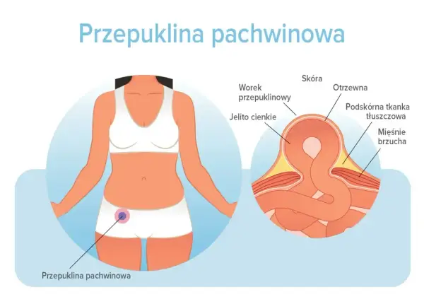 Ilustracja pokazuje, gdzie może być przepuklina pachwinowa – uwypuklenie jelita cienkiego przez osłabione mięśnie brzucha.
