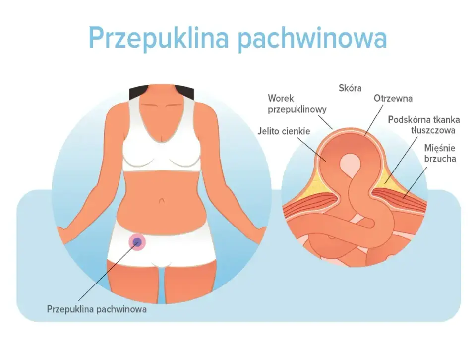 Przepuklina - gdzie boli i kiedy wymaga pilnej pomocy?